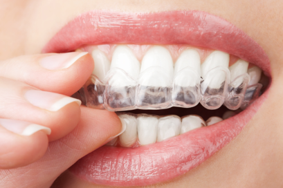 affordable invisalign west hempstead ny